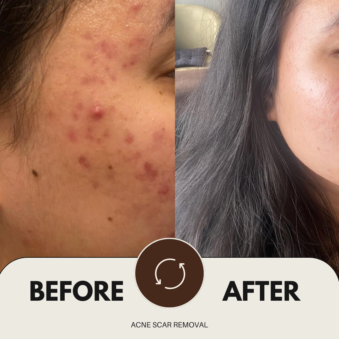 Acne Scar Removel collage result