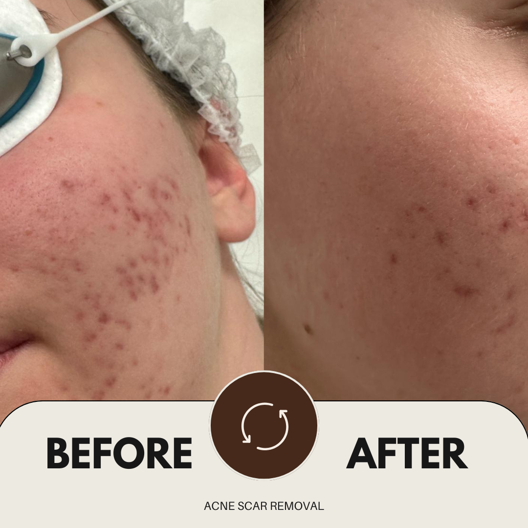 #acne scar removal collage result