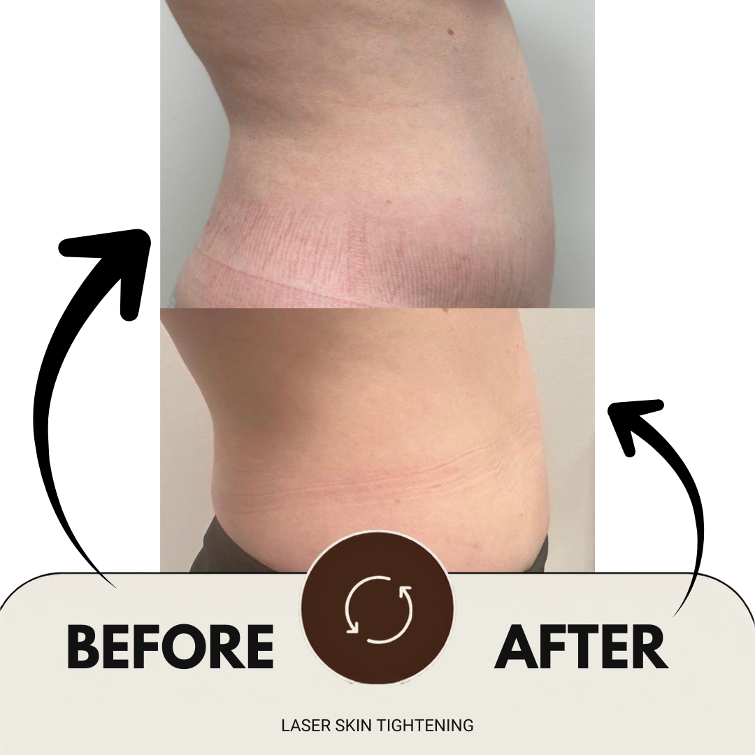 Laser skin tightening before and after result at Olive Skin Aesthetics